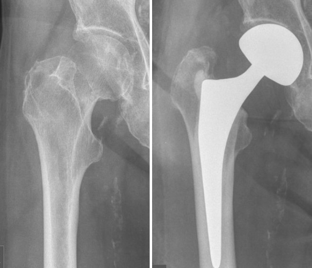 Femoral Neck Fracture Agile Ortho 1596