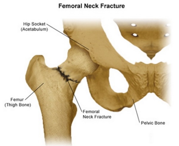 Femoral Neck Fracture Agile Ortho 1326