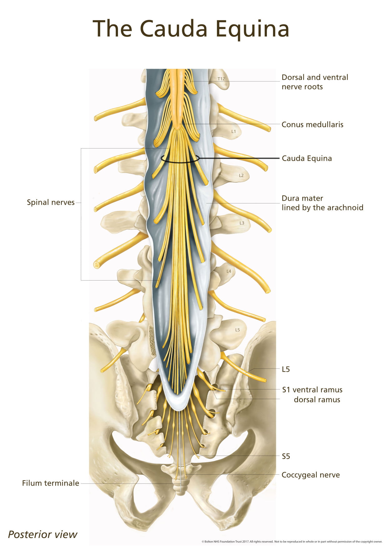 cauda equina vs conus medullaris syndrome