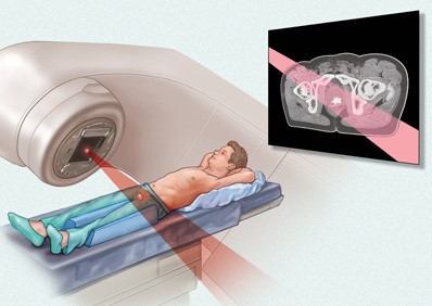 systemic radiation therapy