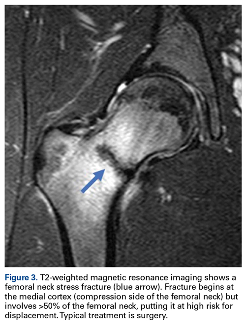 Femoral Neck Stress Fractures Agile Ortho 8461