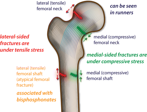 Femoral Neck Stress Fractures Agile Ortho 7129